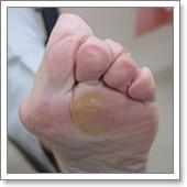 hallux valgus