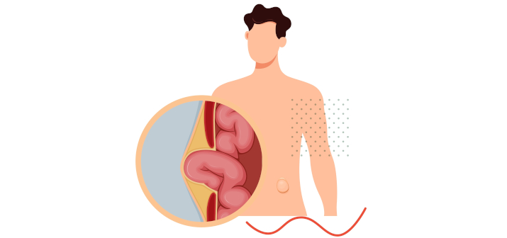 Регулярные запоры и диареи. Когда нужно обратиться к проктологу