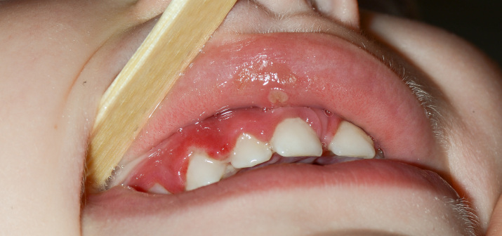 Заболевания слизистой оболочки полости рта