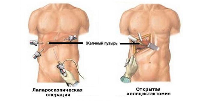 Визуализация раздела Камни в желчном пузыре: варианты лечения