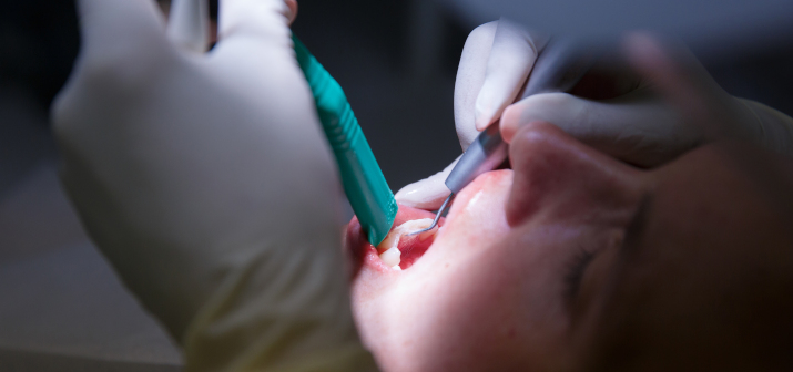 Абсцессы и флегмоны полости рта: различия, риски и лечение