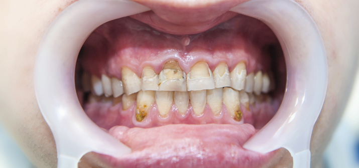 Болезни эмали зубов