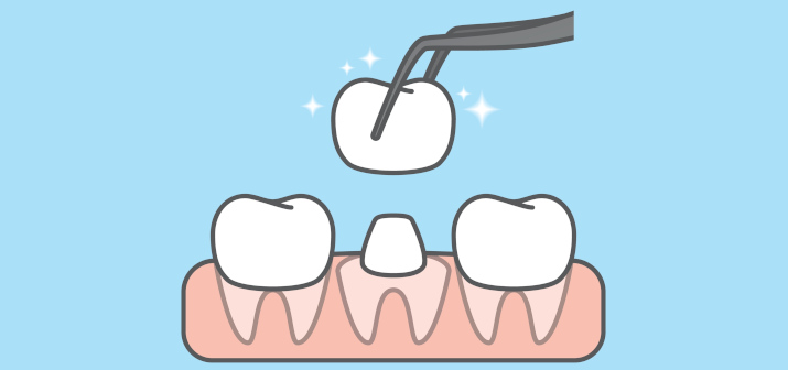 Когда устанавливают коронку на зуб