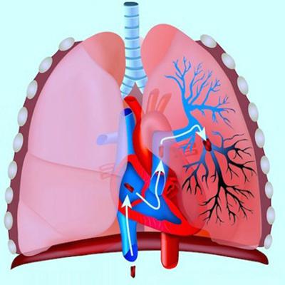 Тромбоэмболия легочной артерии – прямая угроза жизни