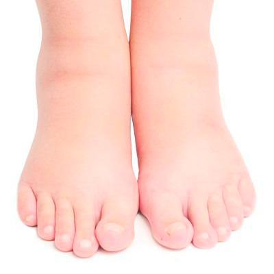Отеки ног: причины и лечение