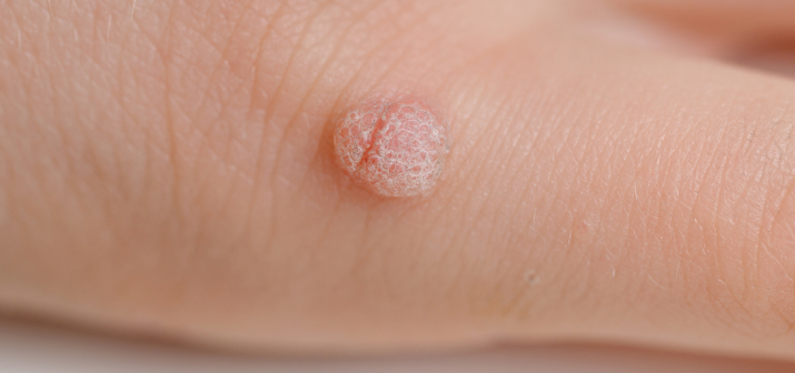 Вирусные бородавки у детей: взгляд хирурга