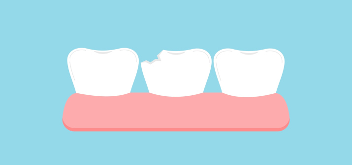 Как восстановить сколотый зуб