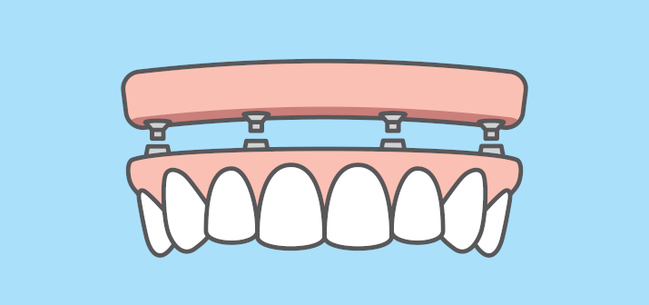 Дентальная имплантация All-on-4 и All-on-6