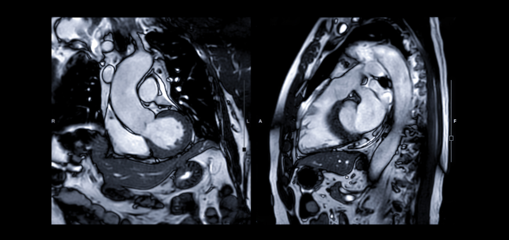 Магнитно-резонансная томография сердца с контрастом