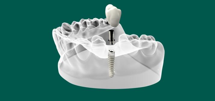 Восстановление и протезирование зубов