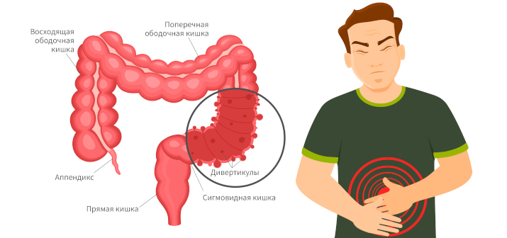 Дивертикулез кишечника