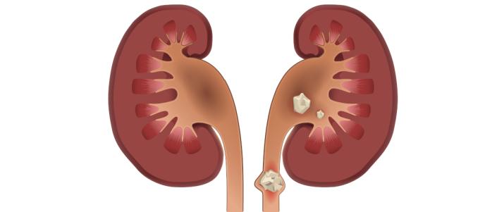 Клинический анализ мочи