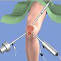 Преимущества метода артроскопии коленного сустава