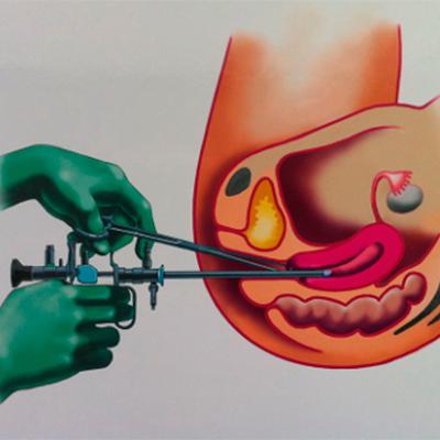 Гистерорезектоскопия: современный метод лечения заболеваний матки
