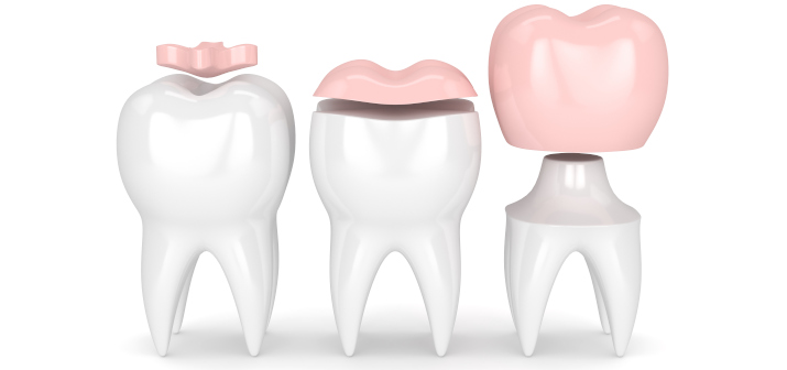 Пломба или реставрация: что лучше при лечении кариеса