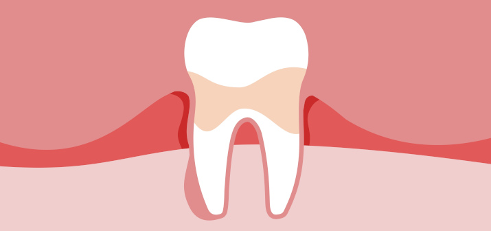 Пародонтальный абсцесс: что это такое, причины, диагностика и лечение