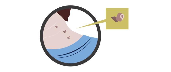 Удаление папиллом на коже