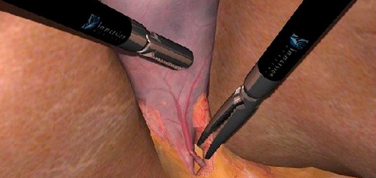 Визуализация раздела Холецистэктомия из мини-доступа