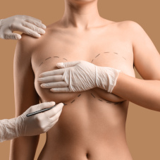 Что такое субмаммарный доступ, и как он используется в пластической хирургии?