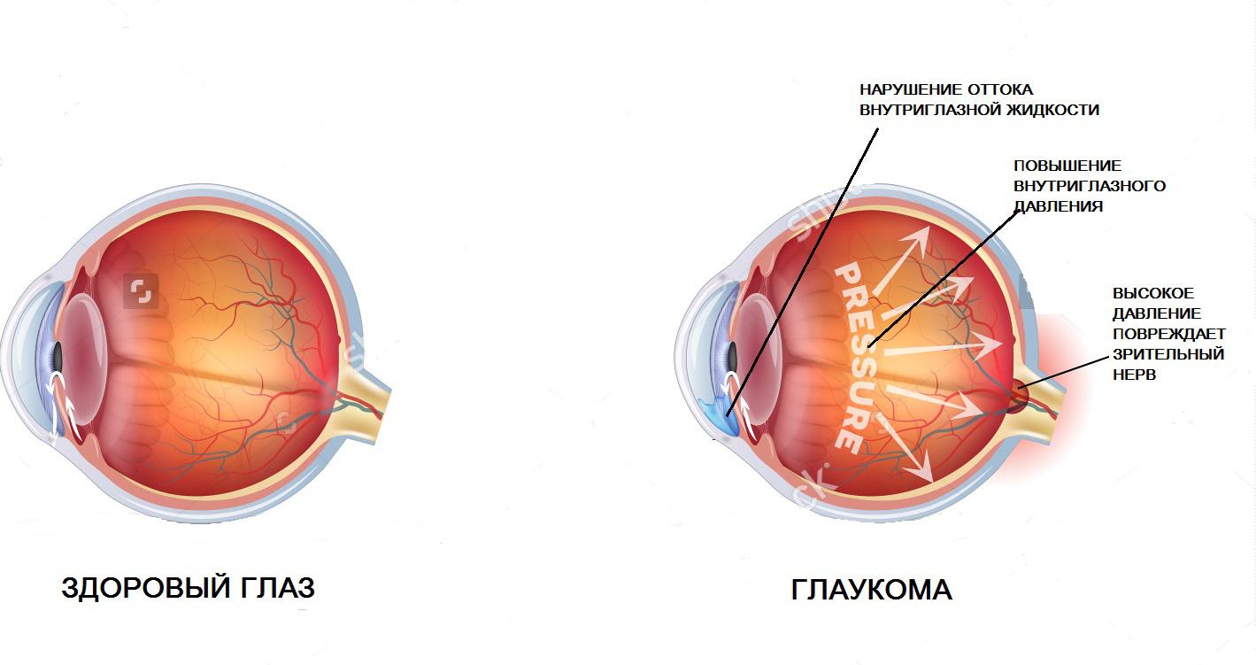 Глаукома: симптомы и лечение