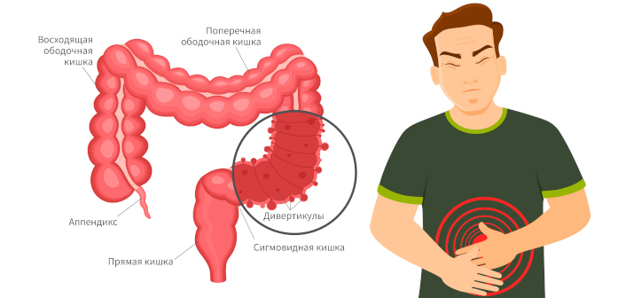 Отек и покраснение ануса. Когда нужно обратиться к проктологу
