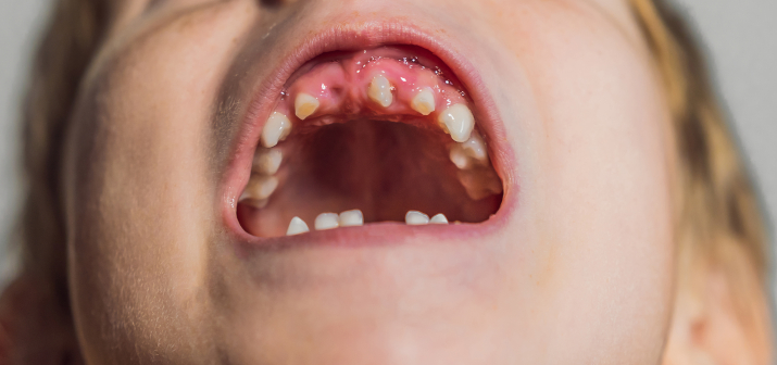 Анатомические патологии зубов
