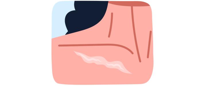 Удаление шрамов лазером