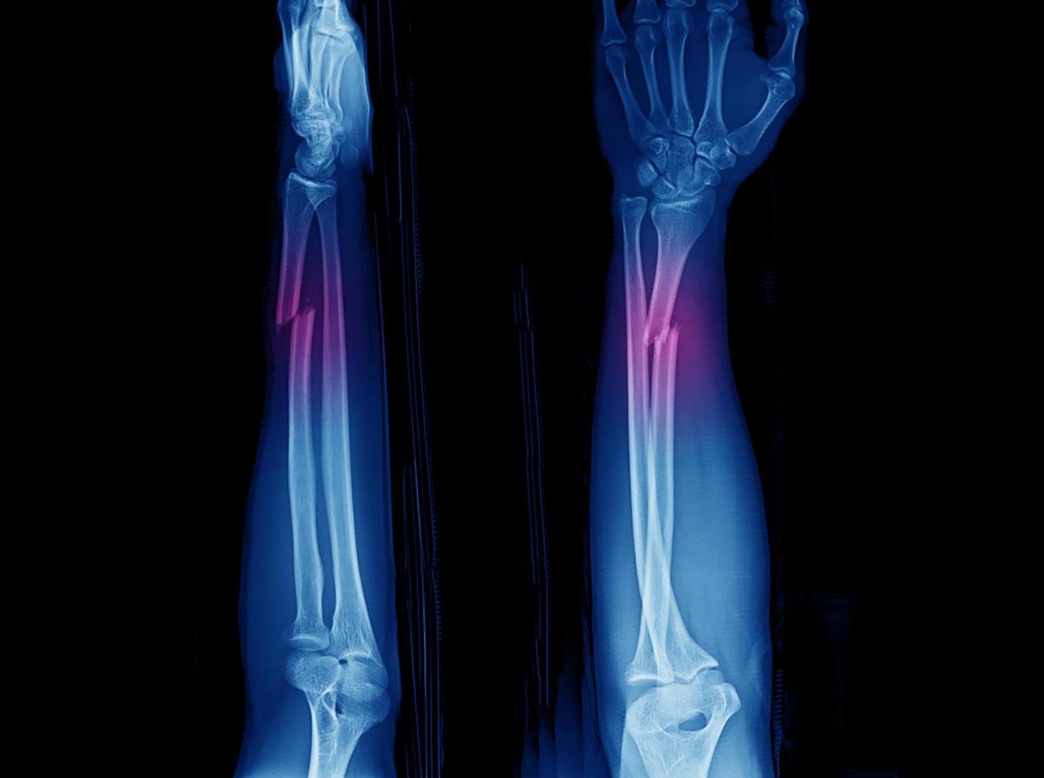 Перелом лучевой кости на рентгеновских снимках в 2-х проекциях