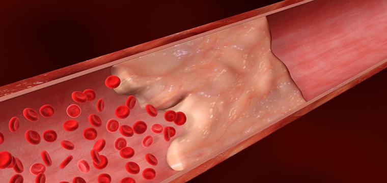Тромбоэмболия легочной артерии – прямая угроза жизни
