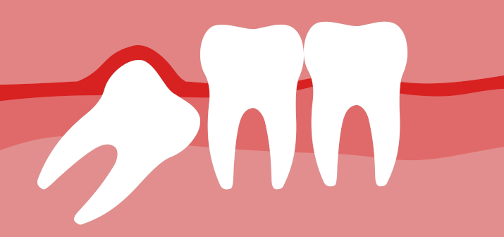 Дистопированные зубы: что делать