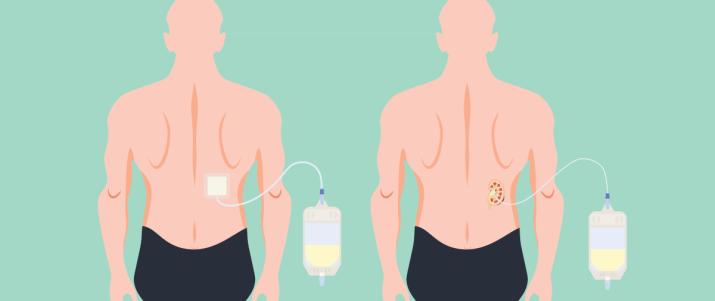 Нефростомия