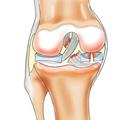 Разрыв мениска: особенности травмы коленного сустава