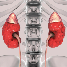 Что такое хроническая болезнь почек, при каких заболеваниях возникает