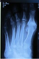 hallux rigidus что это такое