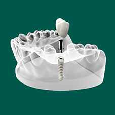 Протезирование и восстановление зубов