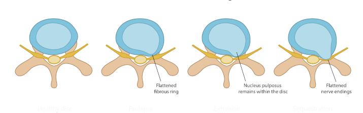 Стадии межпозвоночныой грыжи