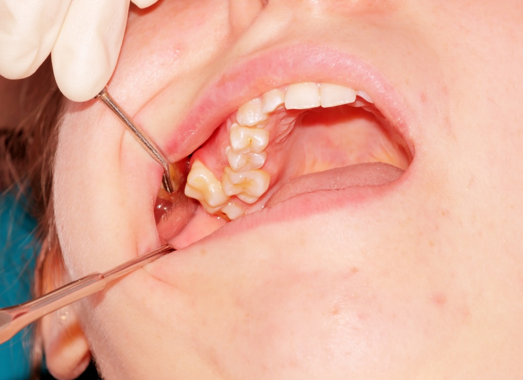 Гипердонтия (появление лишних зубов).jpg