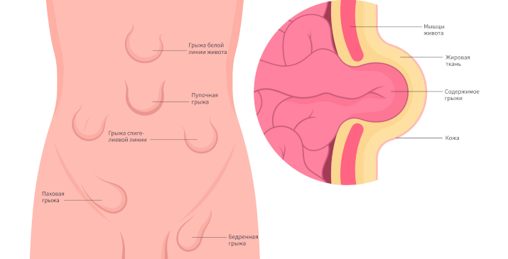Виды грыж живота