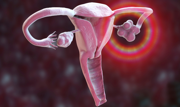 Эндометриоидная киста яичников: что это такое и какое лечение требуется?
