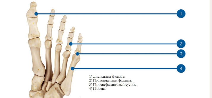 Операции при вальгусной деформации I пальца стопы (коррекция стопы)