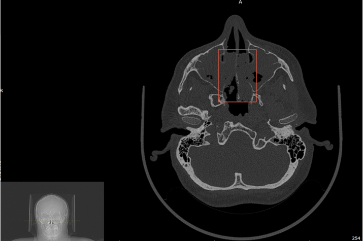 Компьютерная томография носовых пазуъ