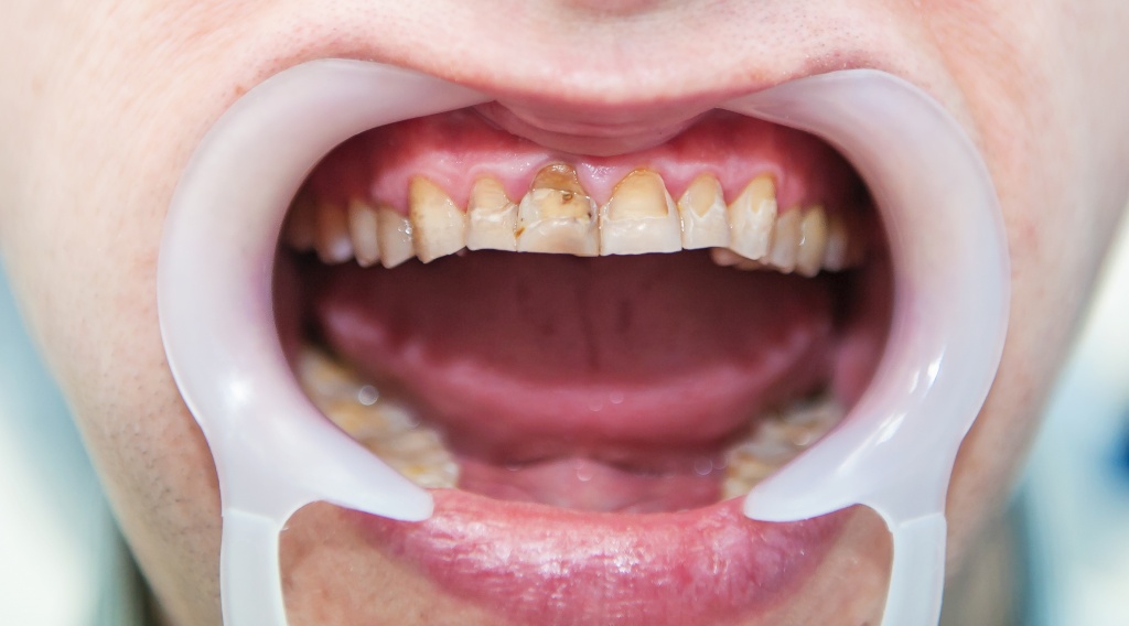 Несовершенный амелогенез - нарушение развития твердых тканей зубов