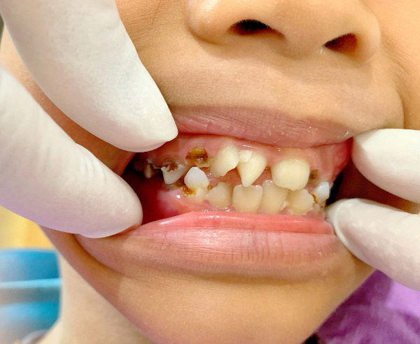 Дистопированные зубы