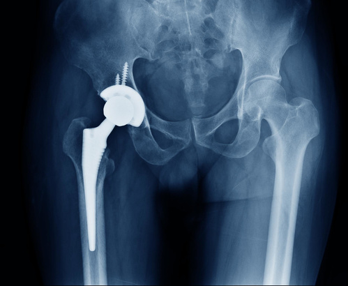 Установленный эндопротез тазобедренного сустава на рентгеновском снимке